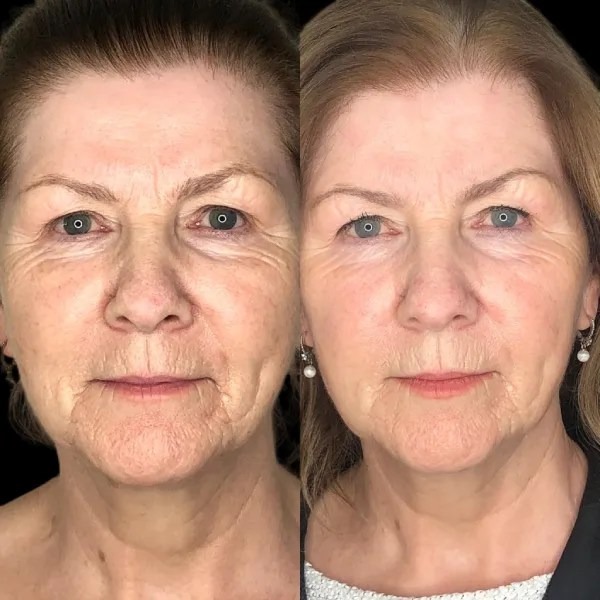 Awaken Radiance using Profhilo Treatment in Dubai
