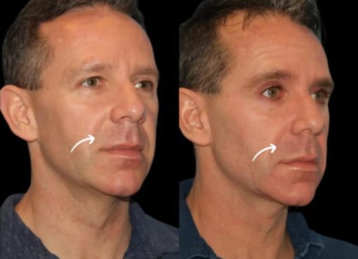 sculptra fillers in dubai