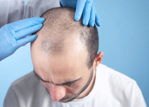 Affordable Hair Transplant Options in Riyadh