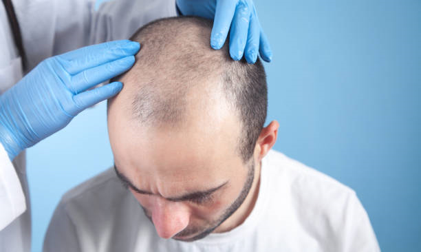 Affordable Hair Transplant Options in Riyadh