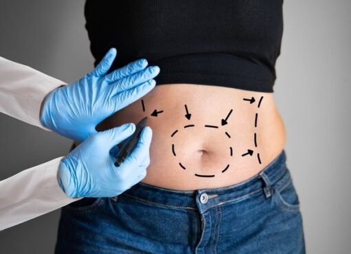 Combining Liposuction and Tummy Tuck Safely Explained