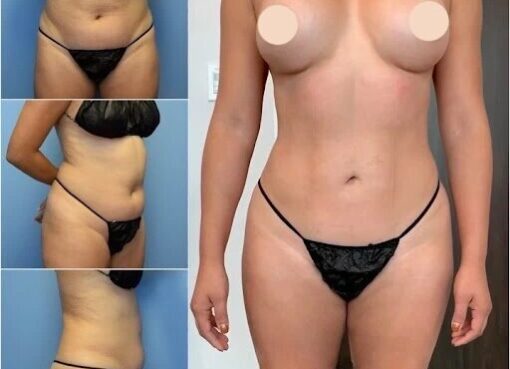 Body Contouring in dubai
