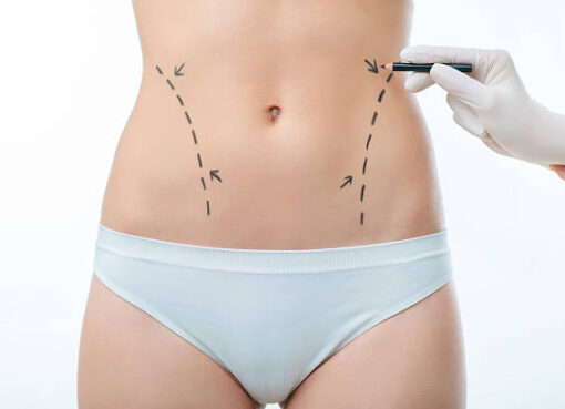 Liposuction in Riyadh
