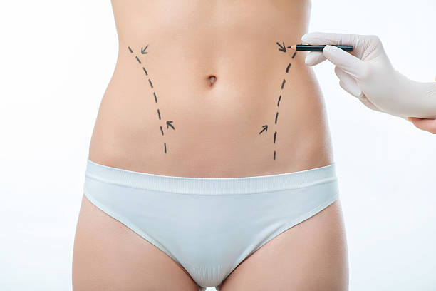 Liposuction Benefits: Is It Right for Your Body Goals?