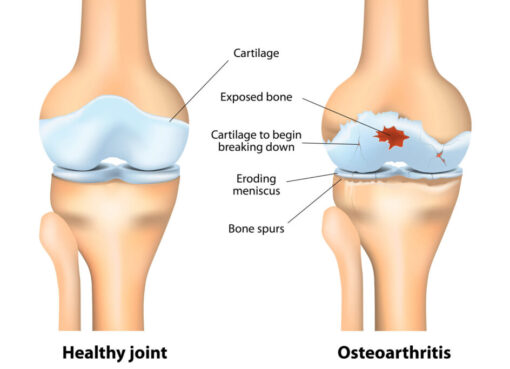 Osteoarthritis icd 10