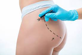 Is Buttock Augmentation Painful? What to Expect During Recovery