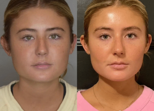 Buccal Fat Removal