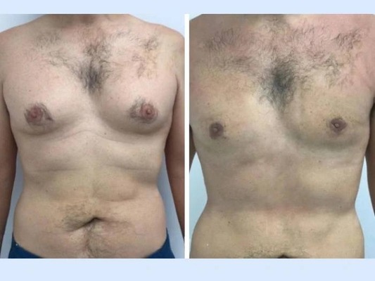 Gynecomastia surgery in Dubai