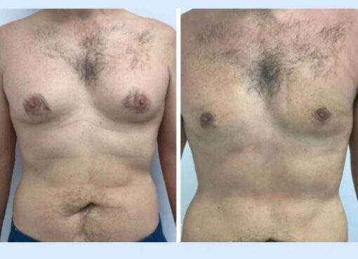 Gynecomastia in dubai