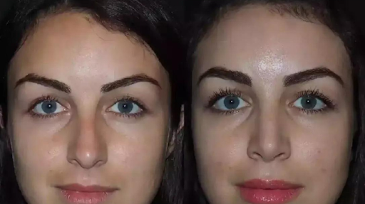 Nose Surgery in Dubai: What You Need to Know Before Treatment