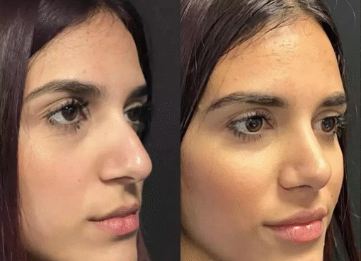 rhinoplasty in dubai