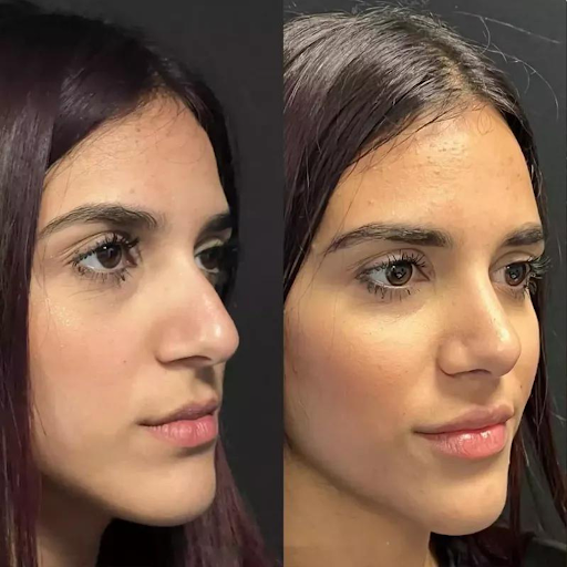 Nose Surgery in Dubai: Safe, Certified, and Reliable