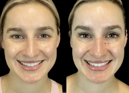 botox in dubai