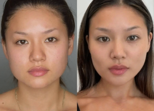 Buccal Fat Removal