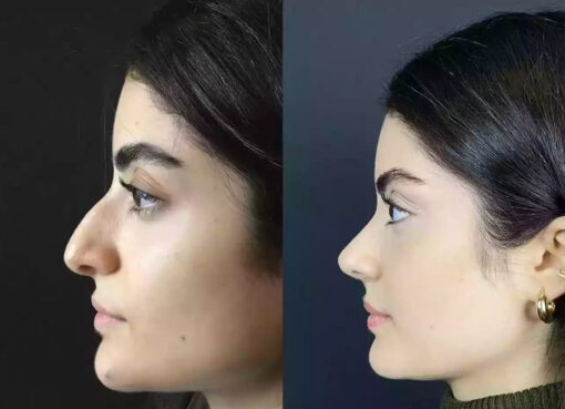 Rhinoplasty in Dubai