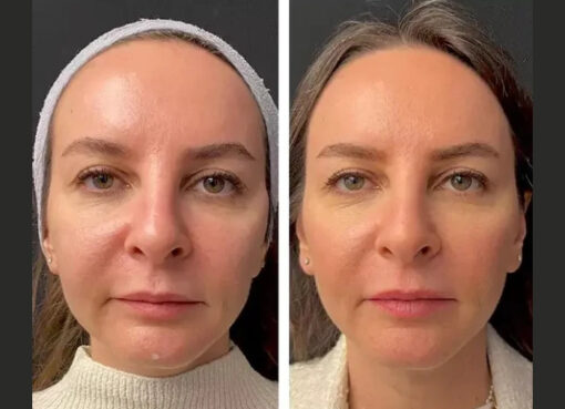 mesotherapy in dubai