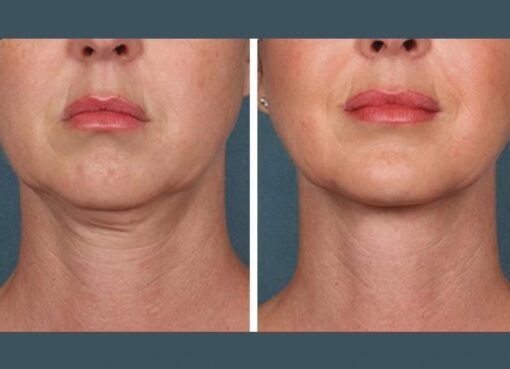 Prp Treatment in Dubai