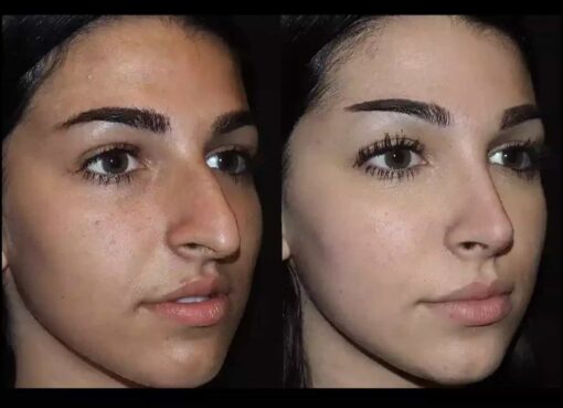Septoplasty in Dubai