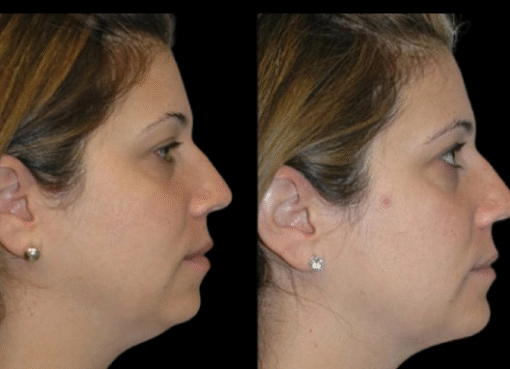 Double chin removal