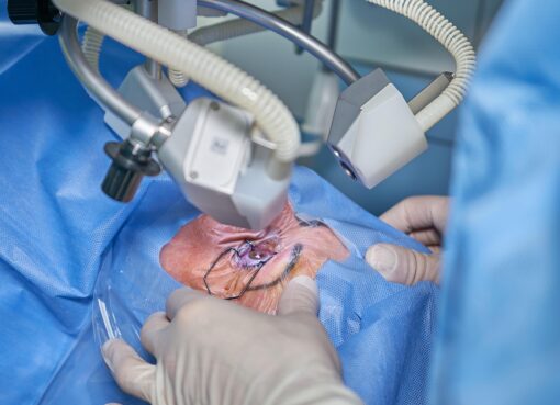 LASIK Surgery in Kerala
