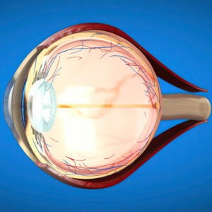 Glaucoma Treatment