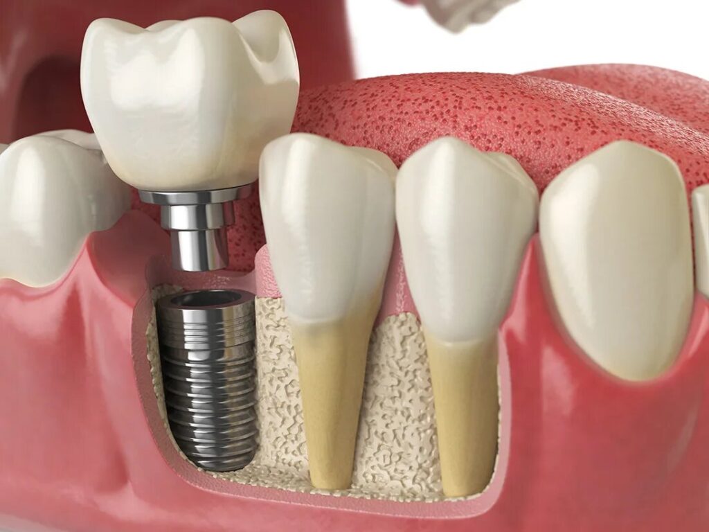 dental implants London