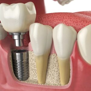 dental implants London