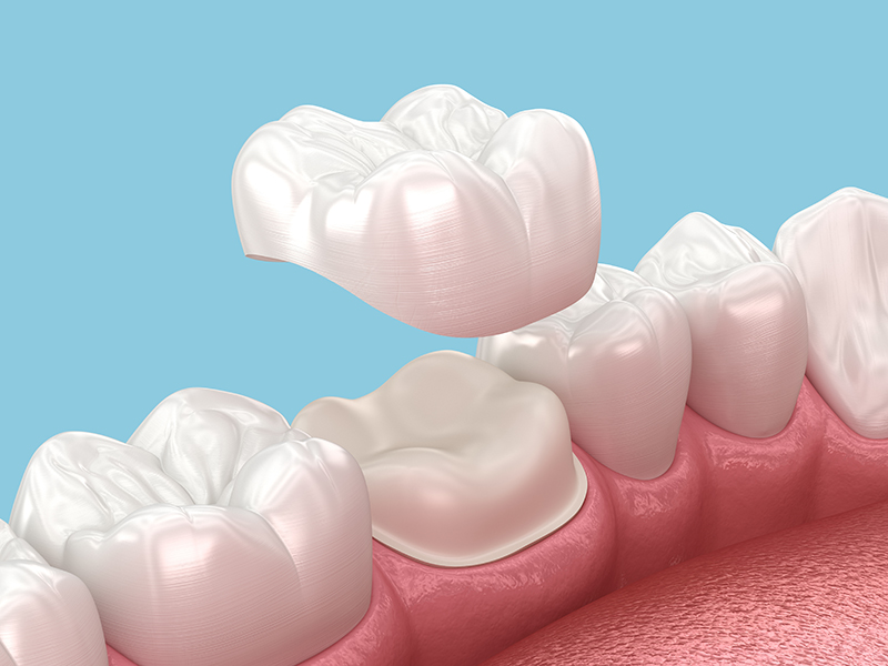 Dental Crowns and Bridges Dubai – Durable & Natural Results