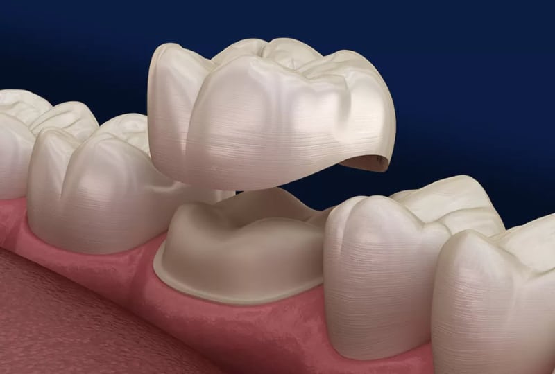 dental crown services