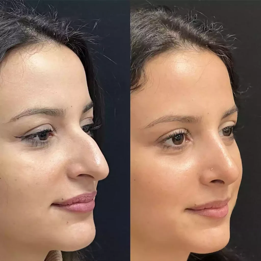 nose surgery in dubai