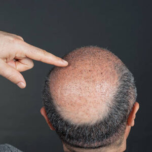 Hair Transplant in Riyadh