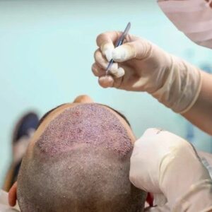 hair transplant clinic in pune