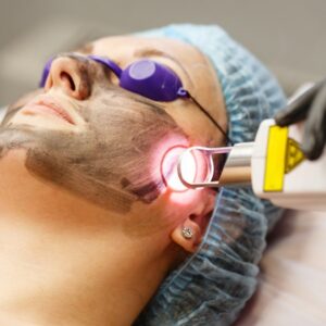 Carbon Laser Peel Treatment