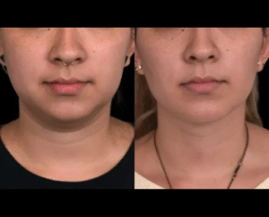 Double chin removal in Dubai