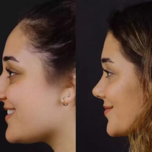 Septoplasty in Dubai