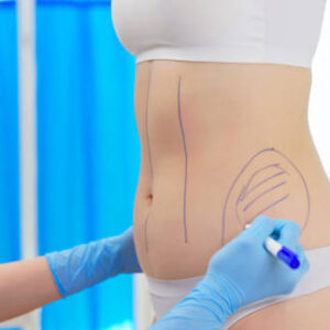 Liposuction in Dubai