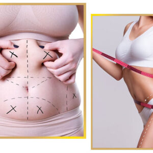 liposuction in islamabad