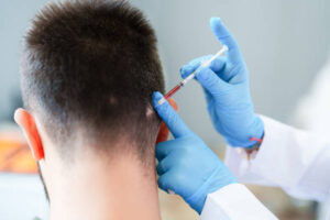 PRP hair treatment in Dubai