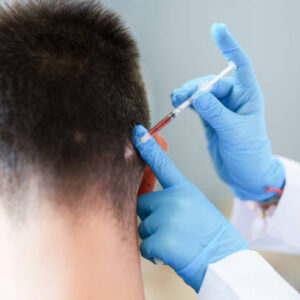 PRP hair treatment in Dubai
