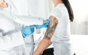 Tattoo Removal in Dubai