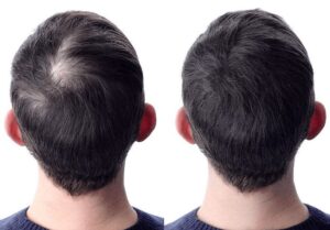 hair transplant clinic in pune