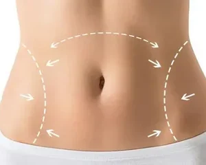 Tummy Tuck Surgery in Riyadh (