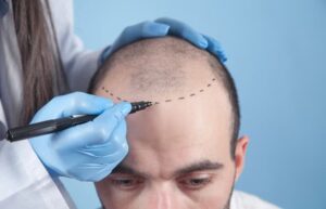 hair transplant clinic in pune