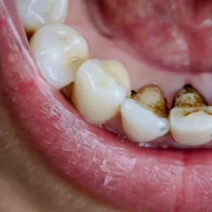 Remove Stains from Teeth