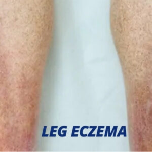 Eczema on legs