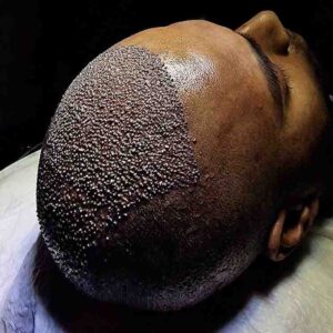 FUE Hair Transplant in Islamabad