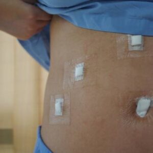 Gallstone Surgery in Dubai