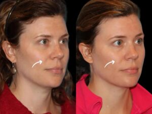 sculptra fillers in dubai
