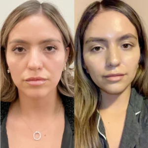 The Rising Demand for Thread Lift Treatment in Dubai Explained