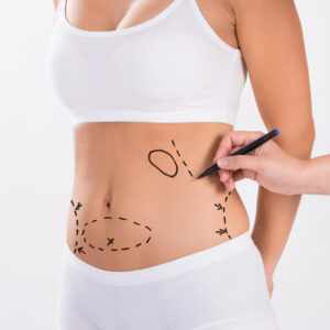 Liposuction in Dubai